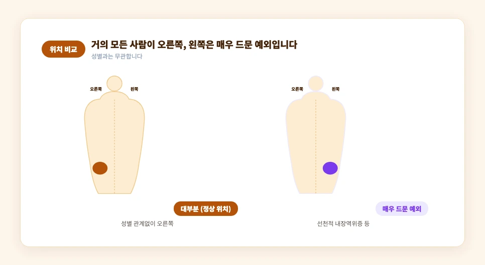 정상적인 맹장 위치(오른쪽)와 드문 예외(왼쪽) 비교